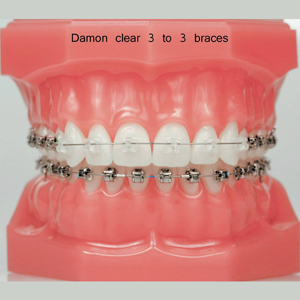 Braces – Dental Art